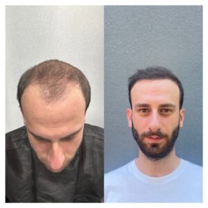 Sapphire Fue Hair Transplant Antalya