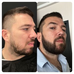 Beard Transplant Antalya