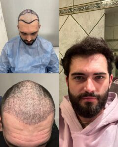 What is DHI Hair Transplant