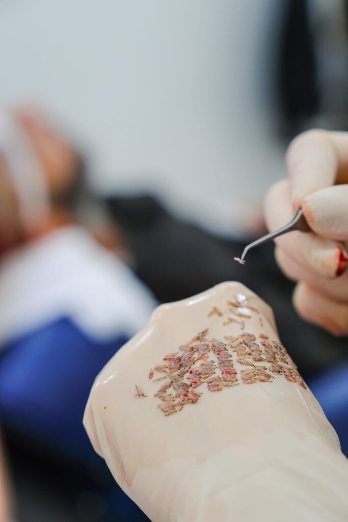 Before After Hair Transplant Antalya