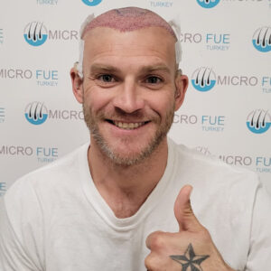 Hair Transplant Antalya Price