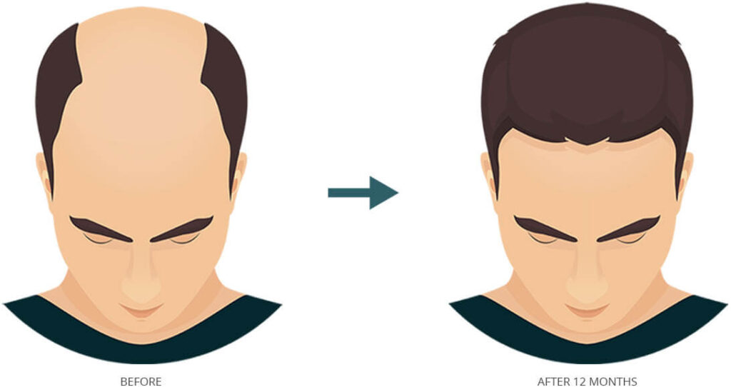 Affordable Hair Transplant Antalya