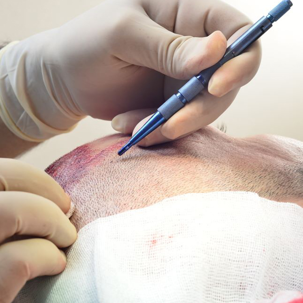UK to Antalya for Hair Transplant
