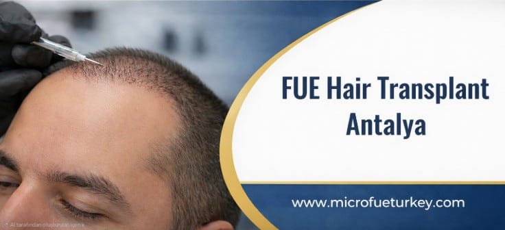 FUE hair transplant before and after results showing natural hairline restoration in Antalya Turkey