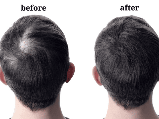 First Three Months After a Hair Transplant