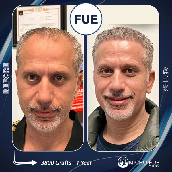 :
FUE hair transplant before and after 3800 grafts 1 year results UK patient Micro FUE Turkey Antalya