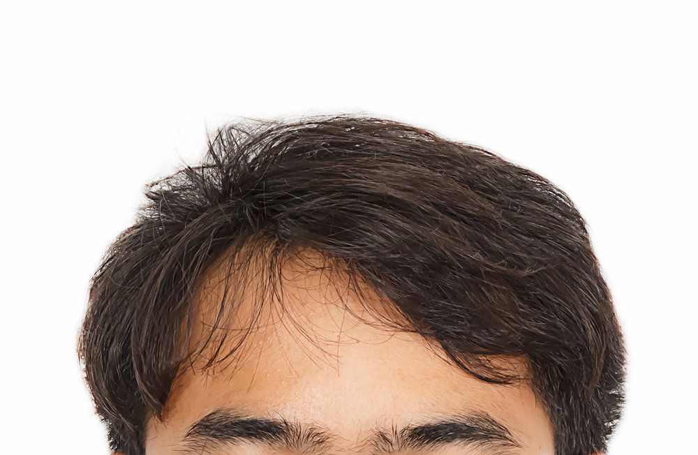 Thyroid and Hair Loss
