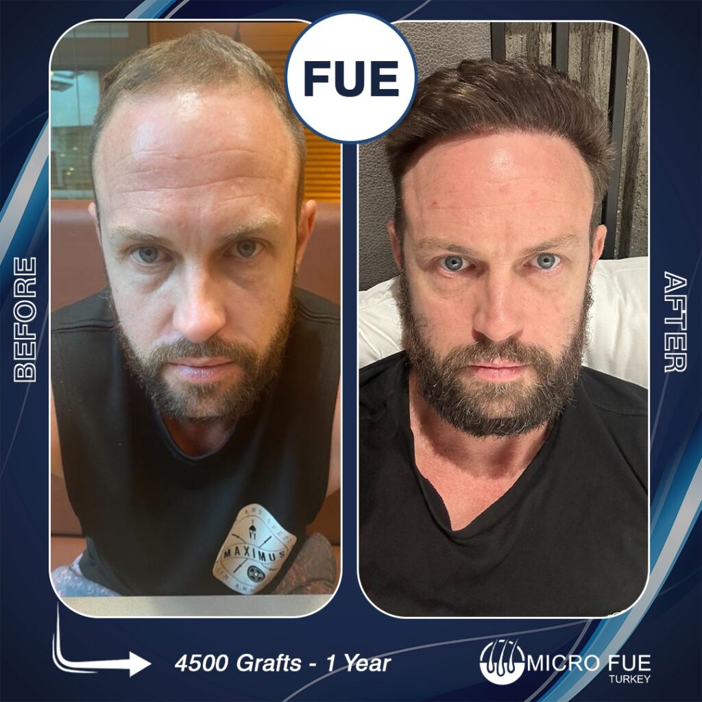 What is Fue Hair Transplant