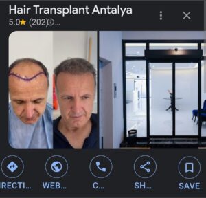 Hair Transplant Antalya from Scotland