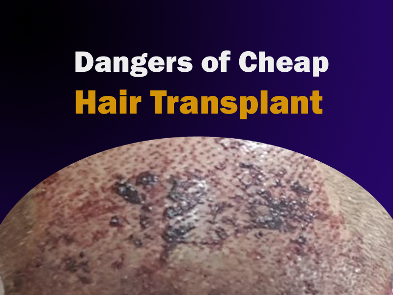 The Danger of Cheap Hair Transplant: A Tale Of Compromise