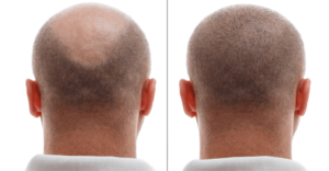 Hair Growth Stages After Hair Transplant