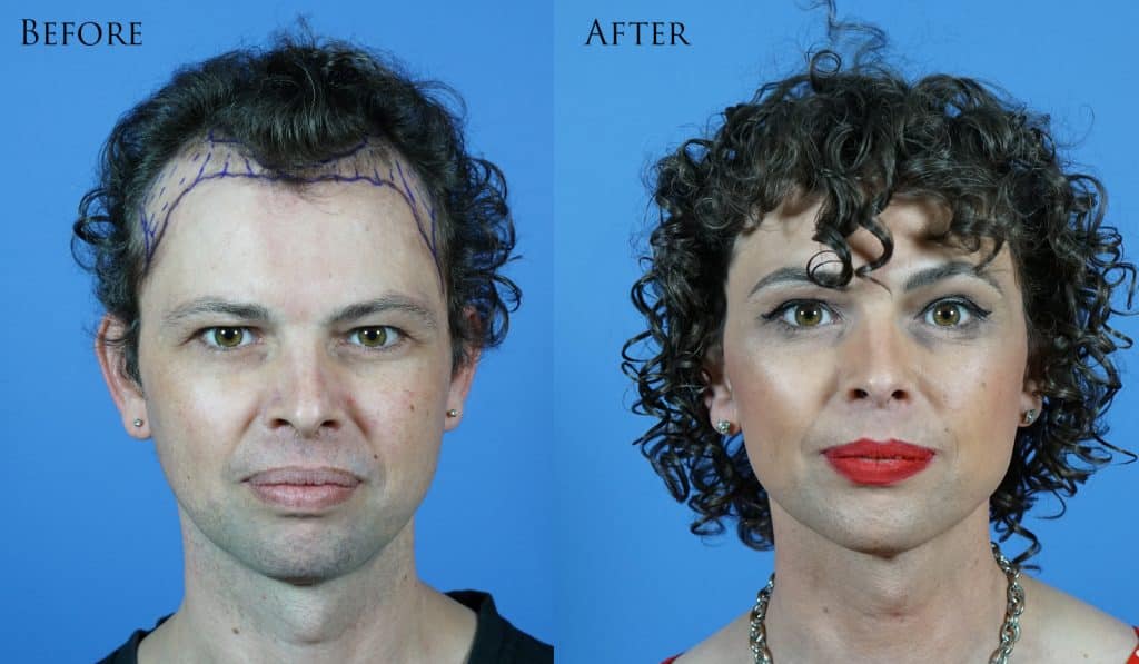 hair transplant for patients who are transgender