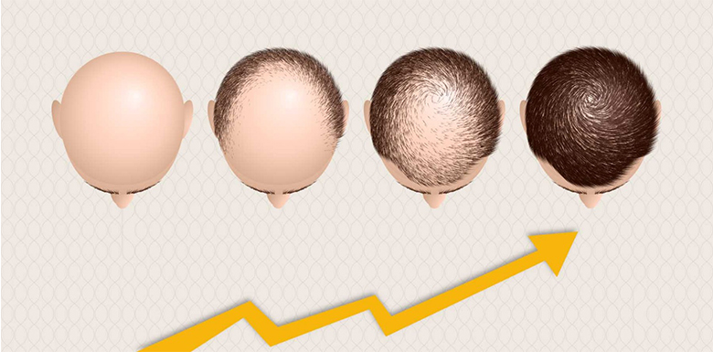 How Many Grafts Do I Need for A Hair Transplant?