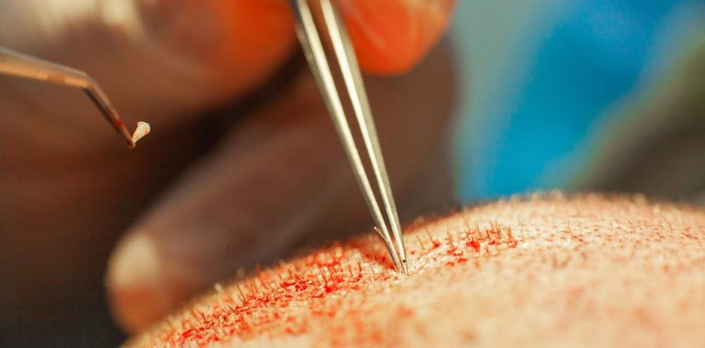 How to Book Your Hair Transplant in Antalya