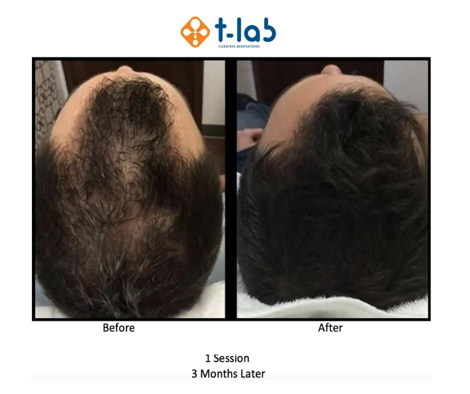 STEM CELL HAIR TRANSPLANT