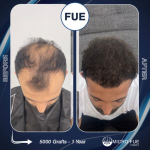 UK Travelers Coming to Antalya for Hair Transplants and Vacation