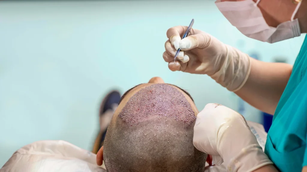 Best Hair Transplant in Antalya, Turkey