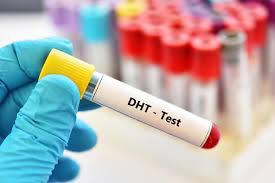 DHT Test for Hair Loss
