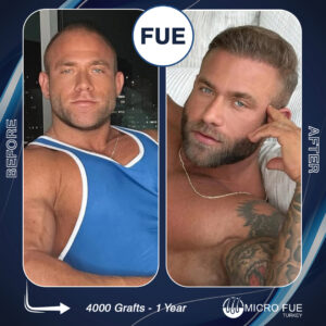 Hair Transplant Antalya