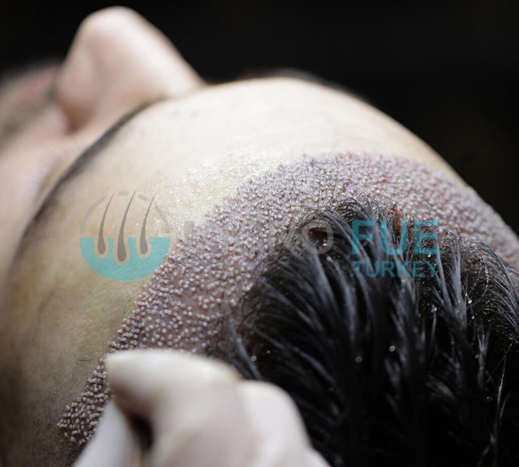 Hair Clinic Antalya