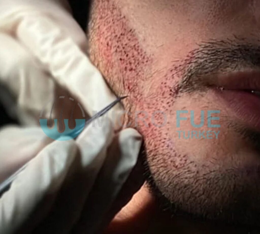 Mustache Transplant in Turkey