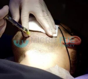 Painless Local Anesthesia in Hair Transplant Procedures