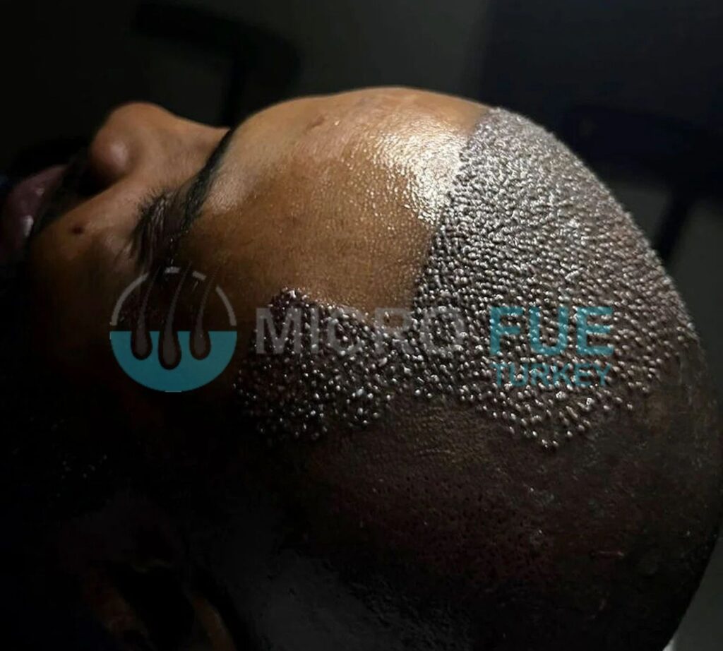 Don’t Let Price Be the Reason You Regret Your Hair Transplant in Antalya