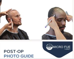 What is the Best Month to Get a Hair Transplant in Antalya?