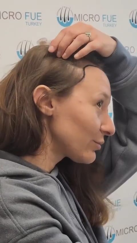 Nano Hair Transplant in Antalya, Turkey