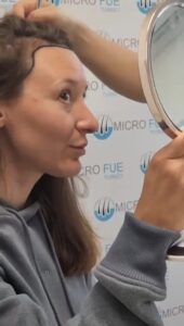 Hair Transplant Process for Women in Antalya