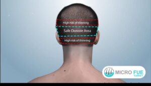 Восстановление области донора после трансплантации волос