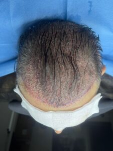 DHI Pen Technique Hair Transplant in Antalya