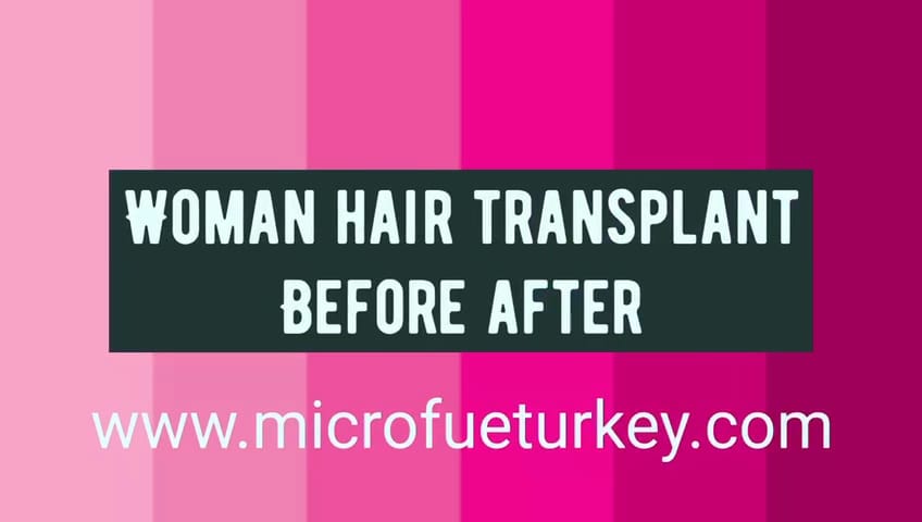 Female Hair Transplant Antalya