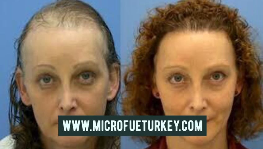 Female Hair Transplant Antalya