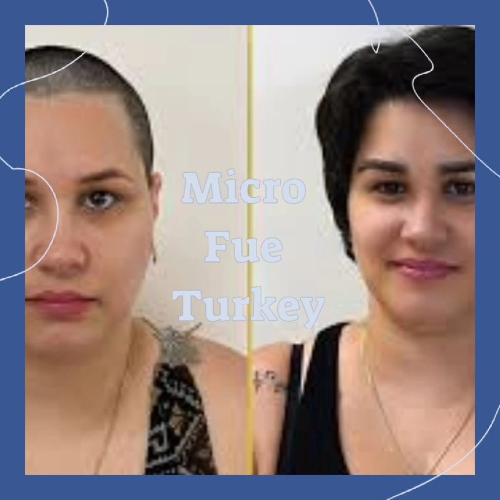 Postoperative Care After Eyebrow Transplant in Antalya