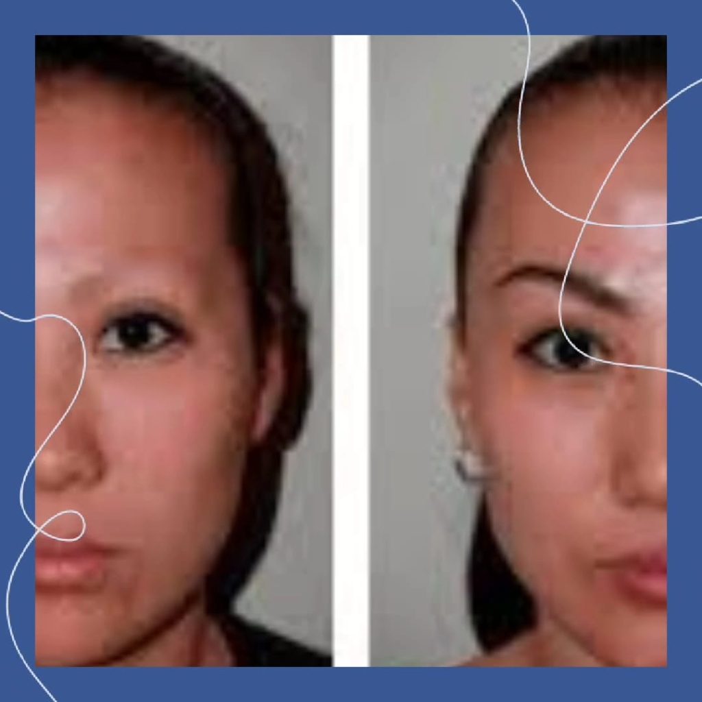 Postoperative Care After Eyebrow Transplant in Antalya