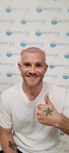Hair transplant Antalya before and after – happy patient result at Micro FUE Turkey clinic