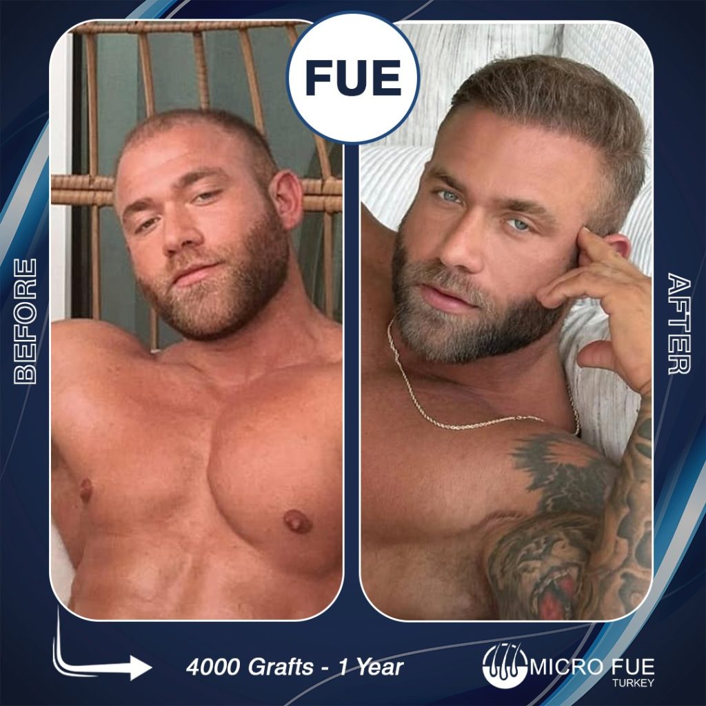 Jake Kenny hair transplant before and after results from USA patient at Micro FUE Turkey Antalya clinic