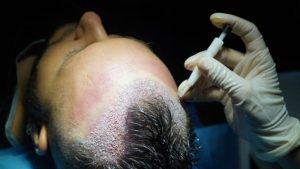 DHI Hair Transplant Antalya Turkey surgeon implanting hair follicles with Choi pen technique for natural hairline restoration