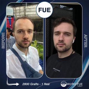 Ilya Antonov Hair Transplant in Antalya showing natural hairline results with advanced FUE technique in a modern clinic in Turkey