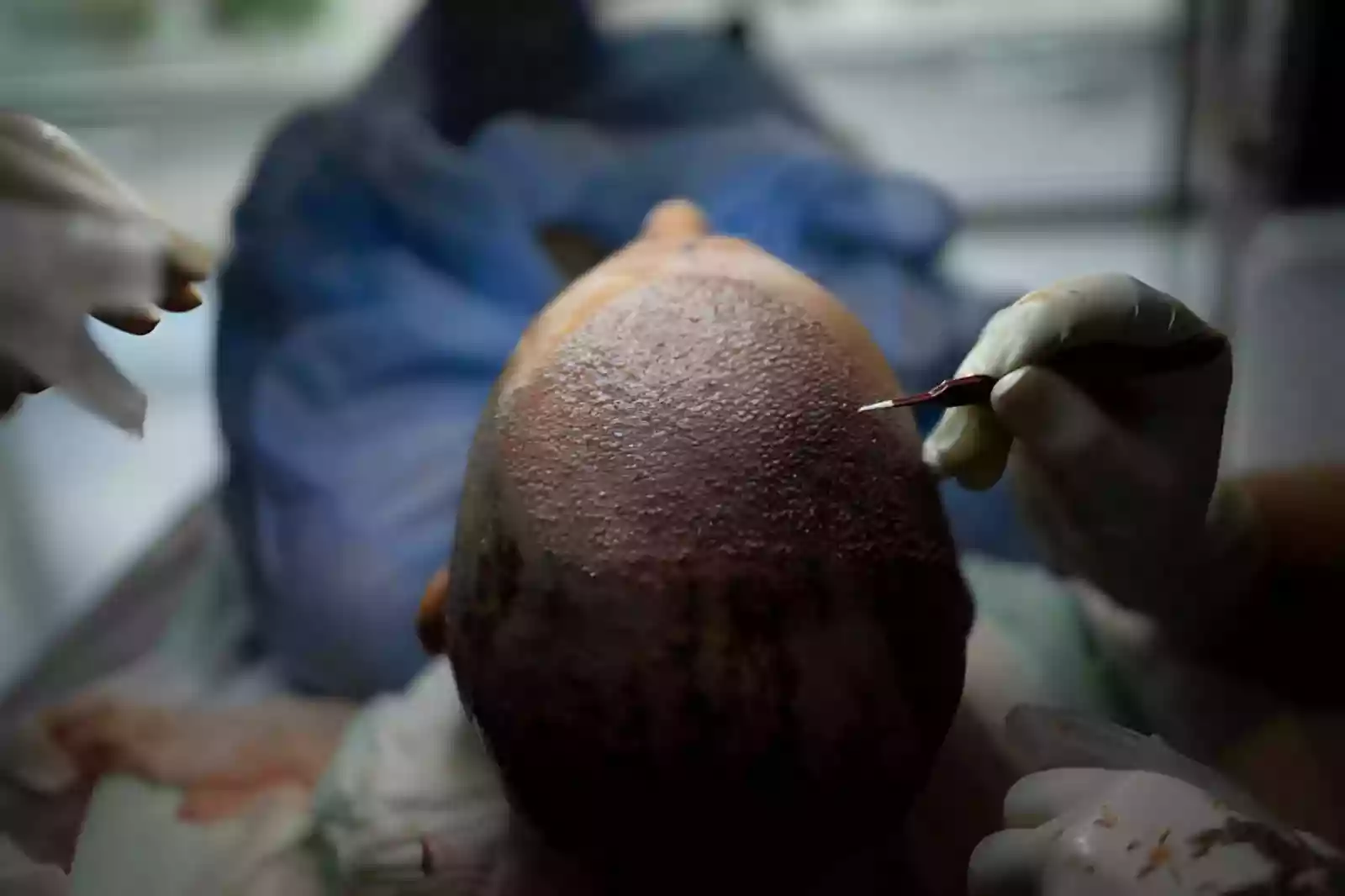 FUE Sapphire FUE and DHI hair transplant techniques in Antalya