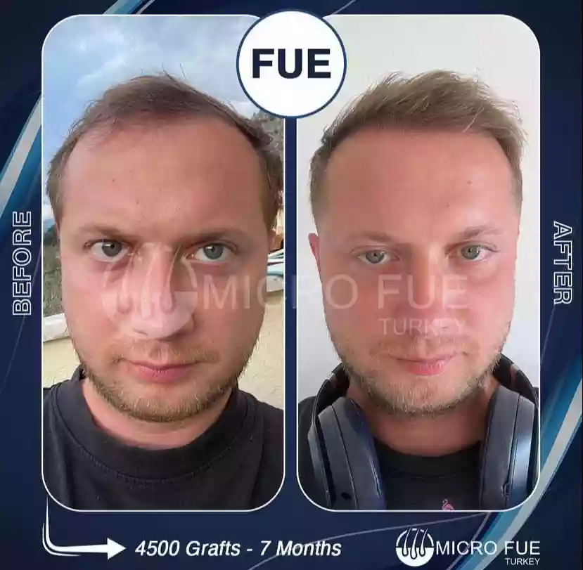 3 Night Hair Transplant in Antalya treatment plan