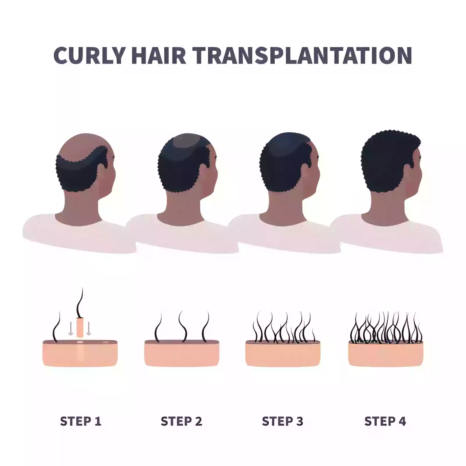 Afro Hair Transplant Istanbul Turkey
