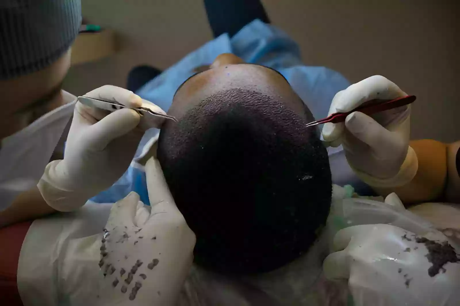 Curly follicle extraction for an Afro Hair Transplant Antalya Turkey
