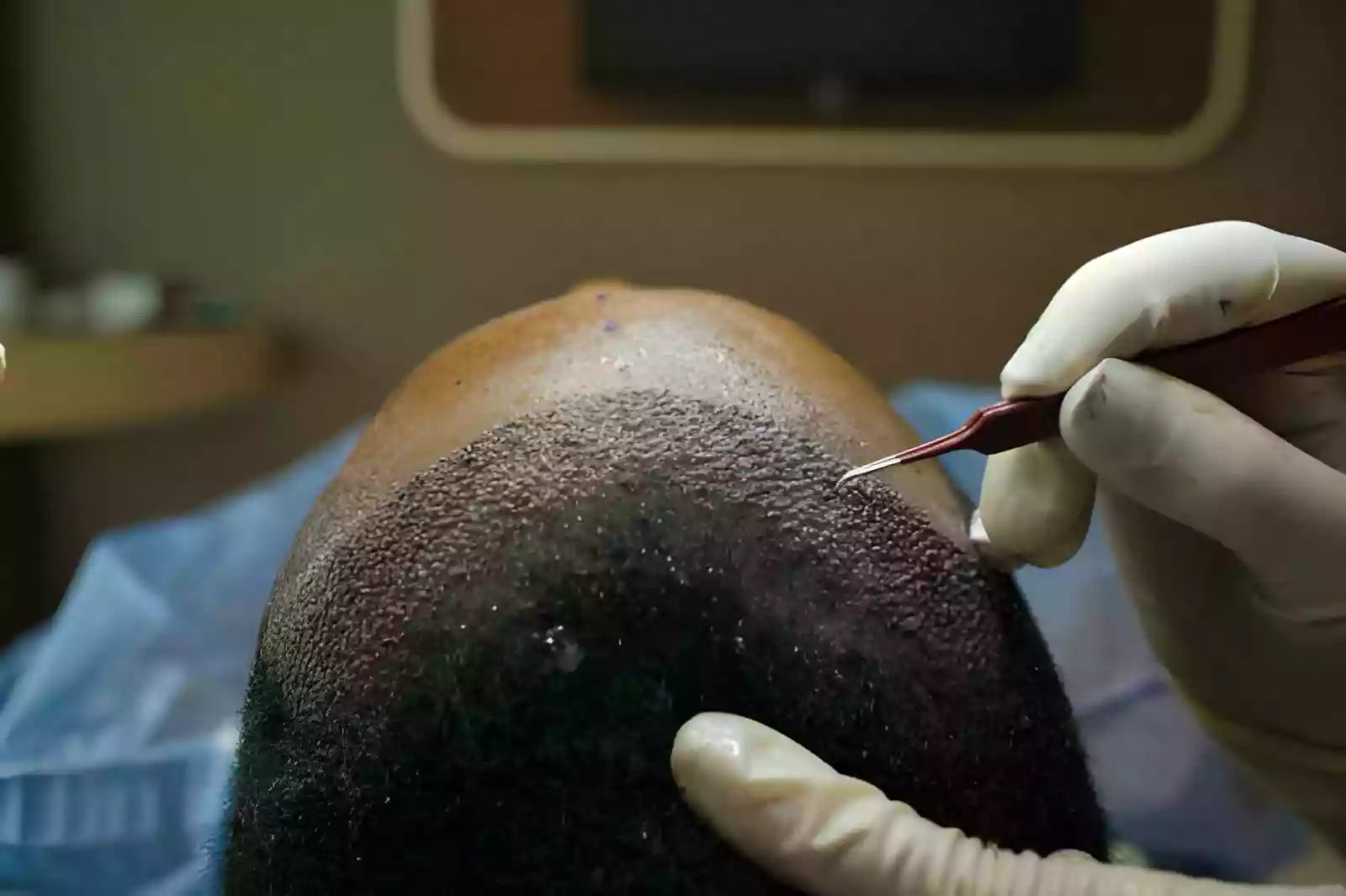 Donor area assessment before an Afro Hair Transplant Antalya Turkey