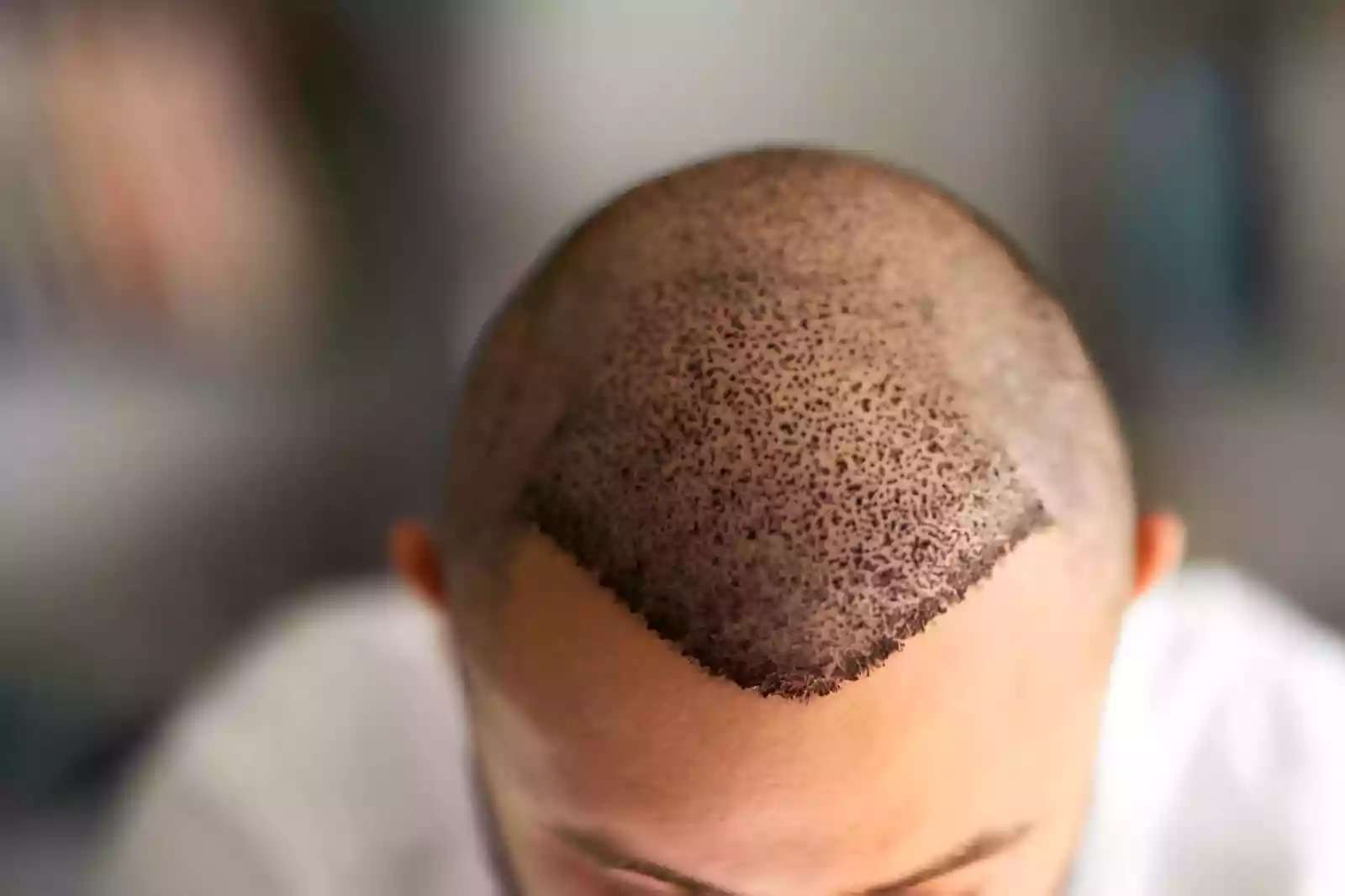 Recovery and growth after Afro hair transplant