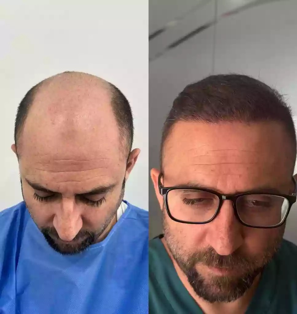 Donor Area Recovery After Hair Transplant