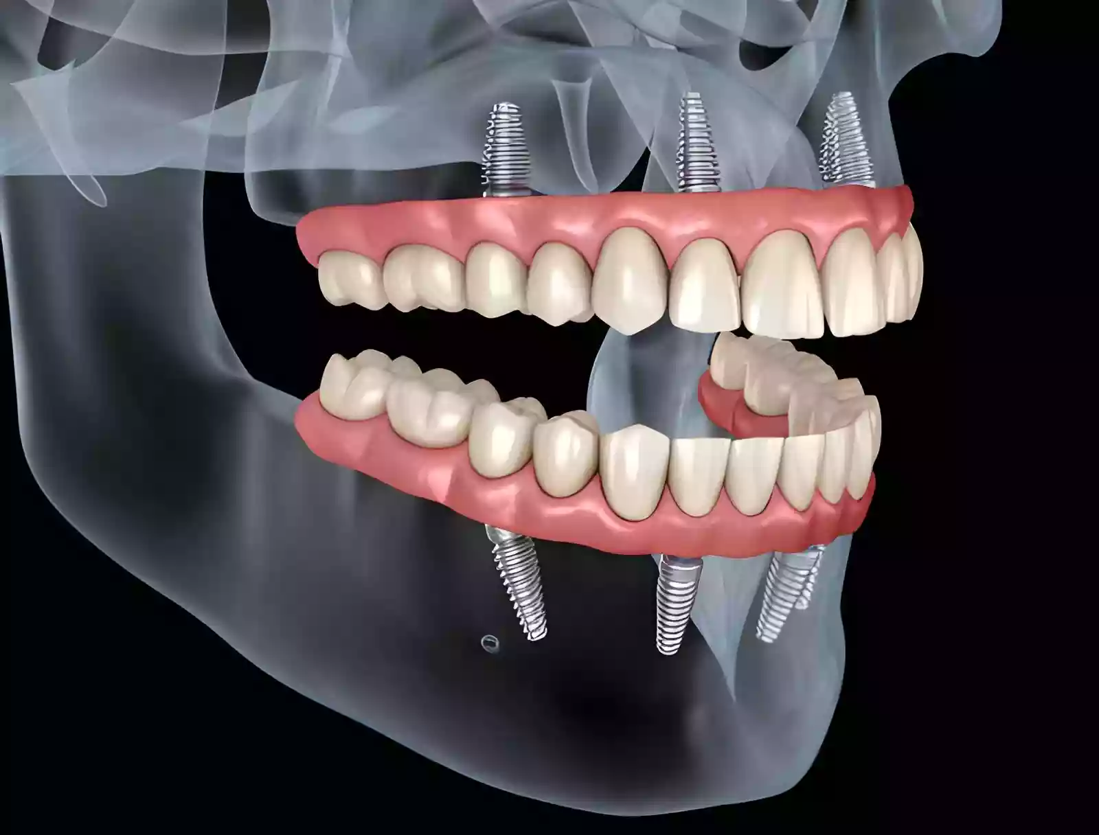 All-on-4 Dental Implant System in Antalya full arch dental implant treatment