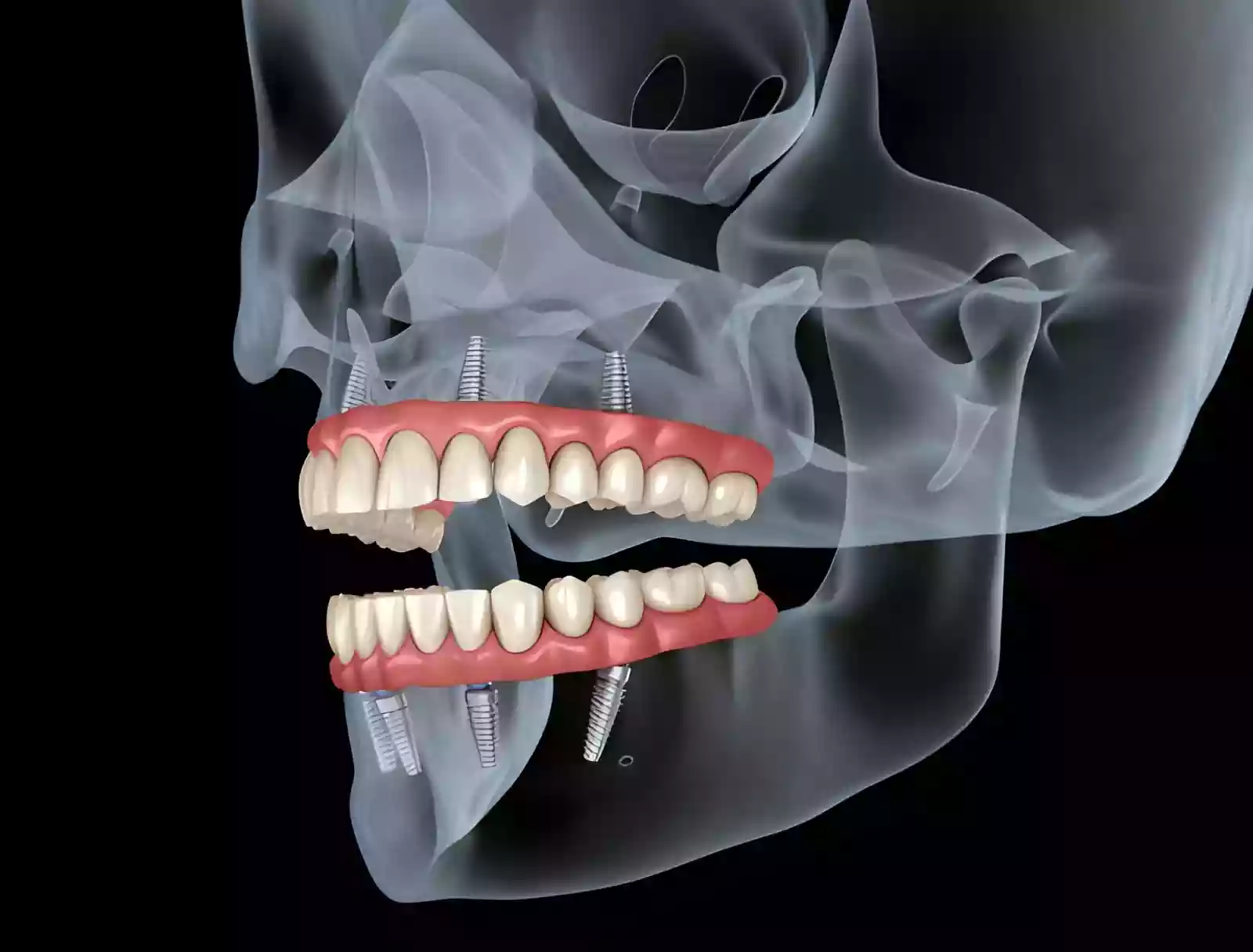 All-on-4 Dental Implant System full arch implant-supported restoration