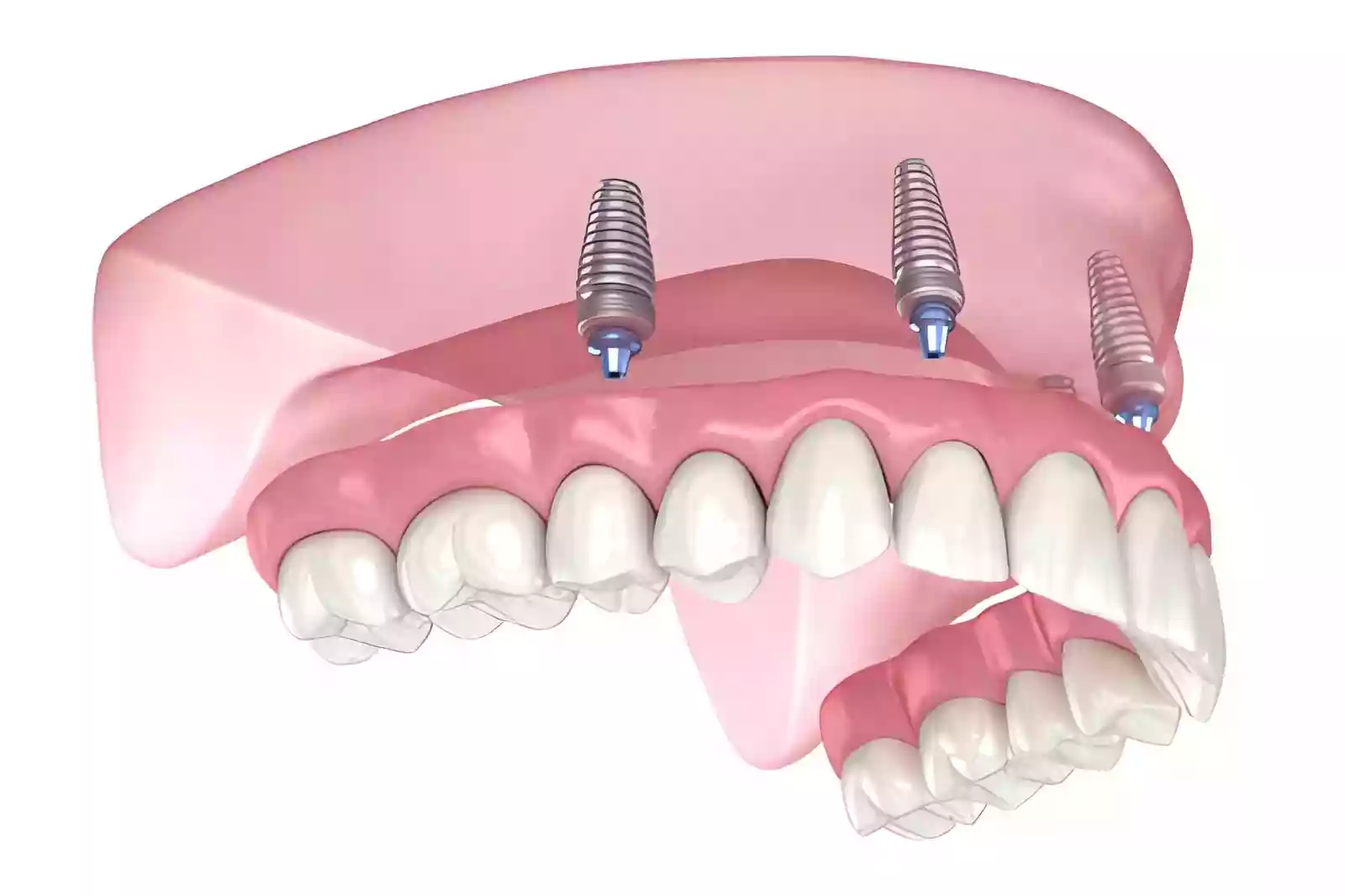All-on-4 Dental Implant System treatment planning and prosthetic restoration